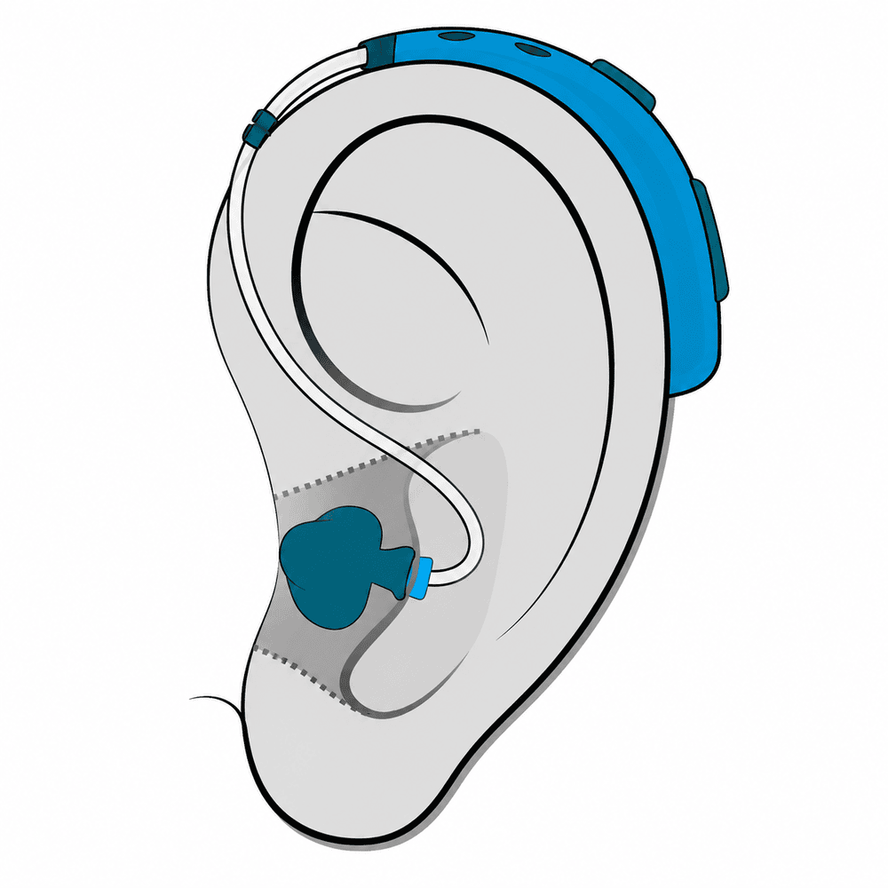 Behind-the-Ear (BTE) hearing aid style available at Comprehensive Hearing Solutions in Southeast Kansas